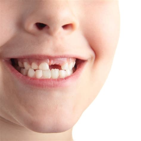 dente nascendo - dente siso podre